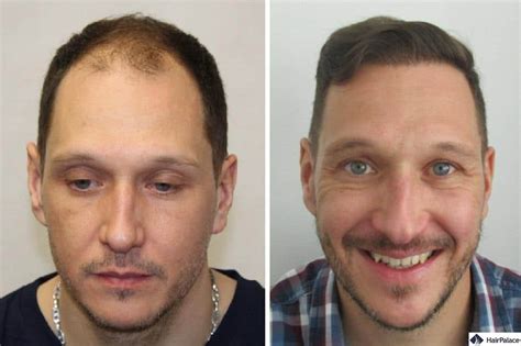 2024 TOP 10 Best Hair Transplant Clinics in the USA + Cost .